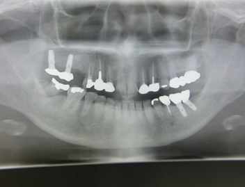 インプラントレントゲン
