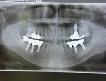インプラントのレントゲン