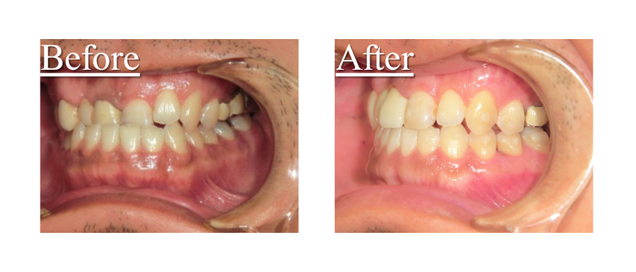 矯正歯科症例１