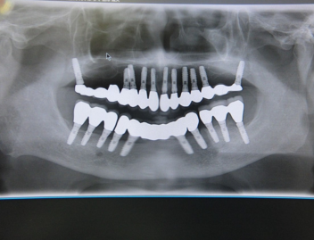 インプラントのレントゲン
