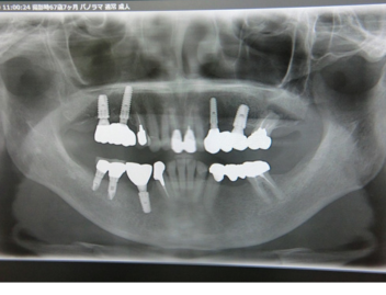 インプラントのレントゲン