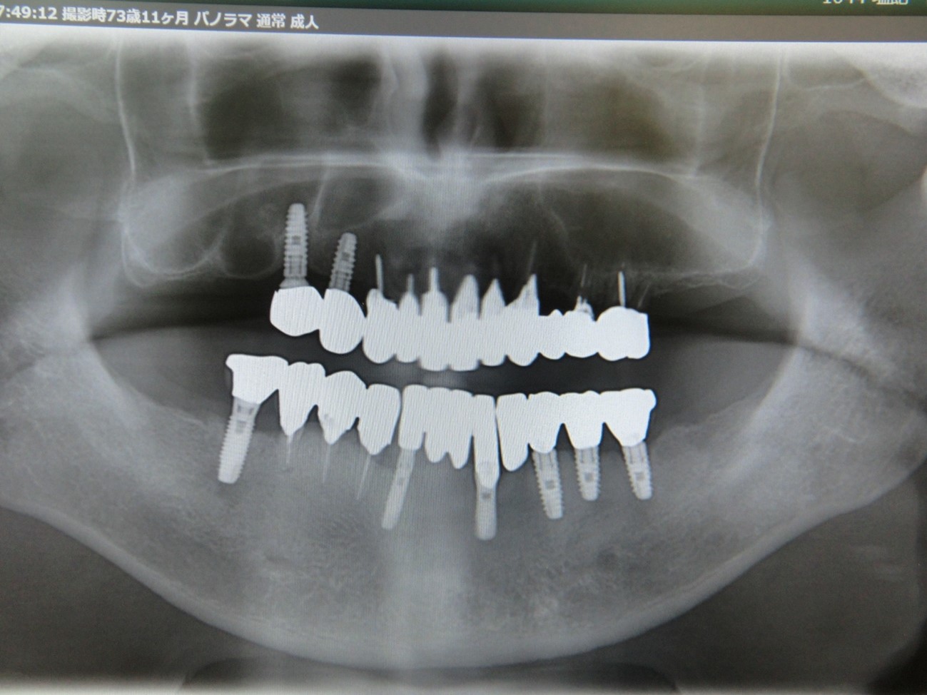 インプラントレントゲン