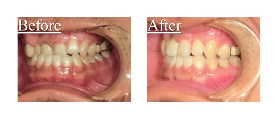 矯正治療とセラミックの症例