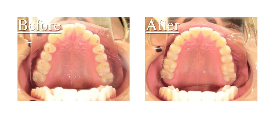 インビザライン症例10