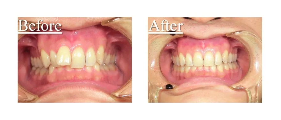 インビザライン症例9