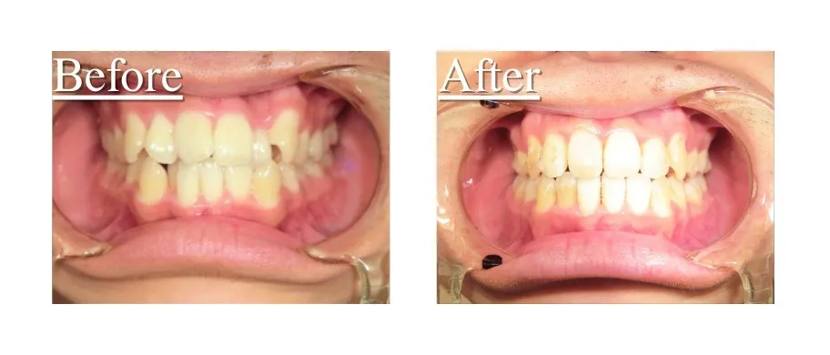 インビザライン症例8