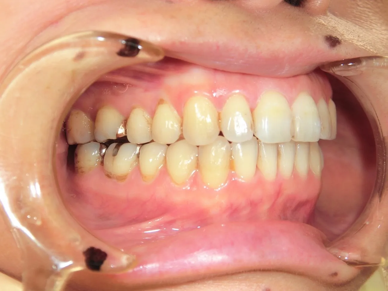 インビザライン症例7