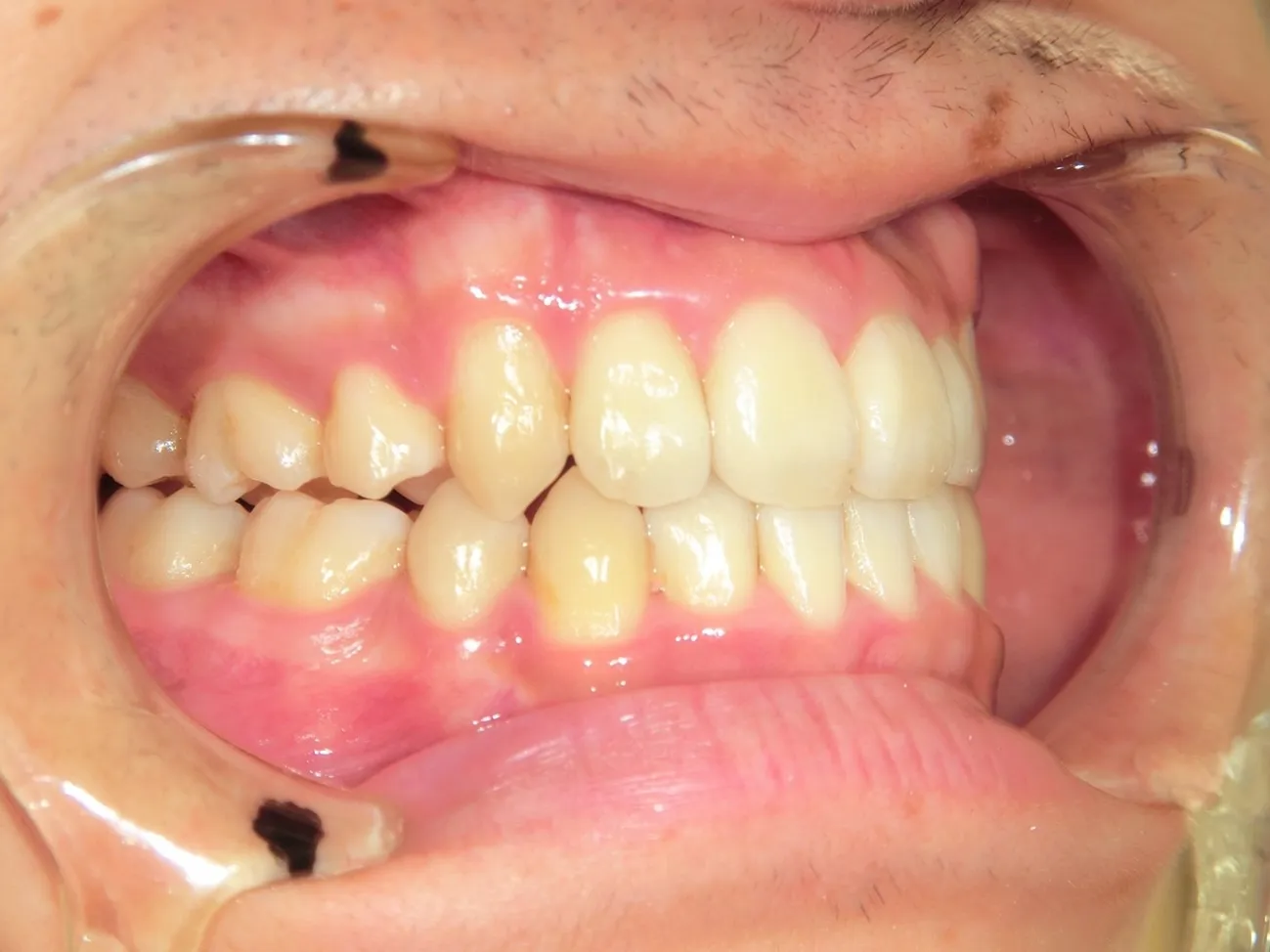 インビザライン症例6