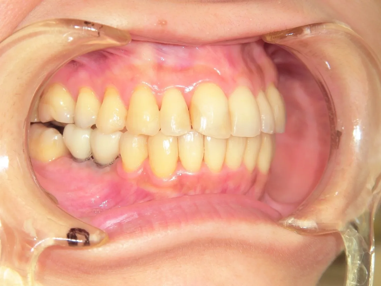 インビザライン症例5
