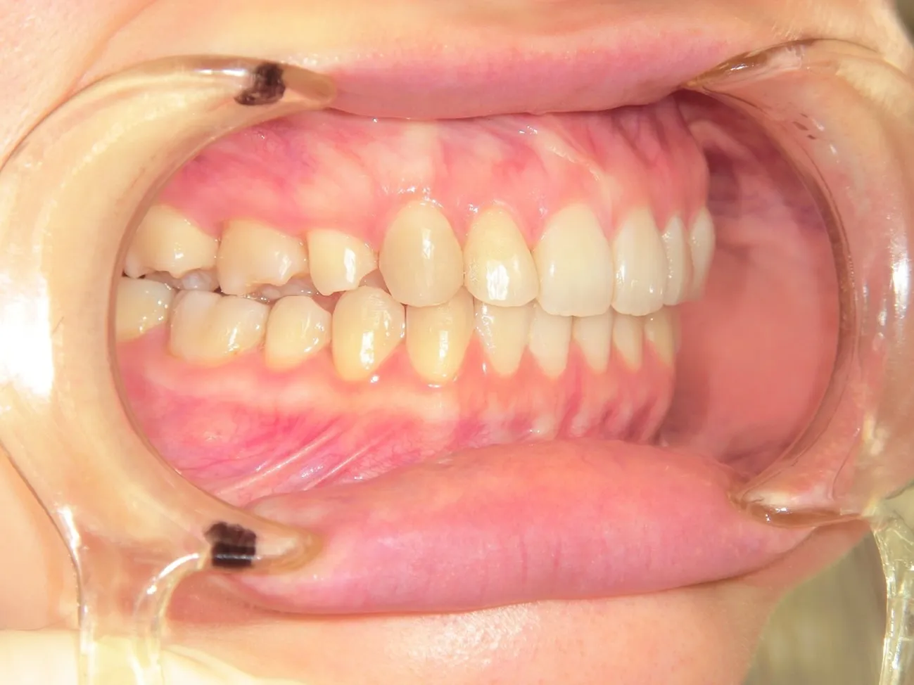 インビザライン症例3