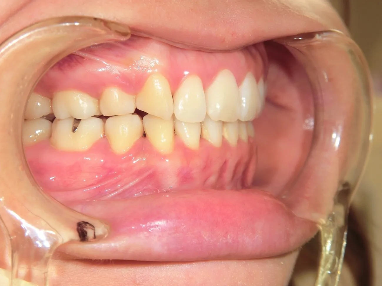 インビザライン症例2