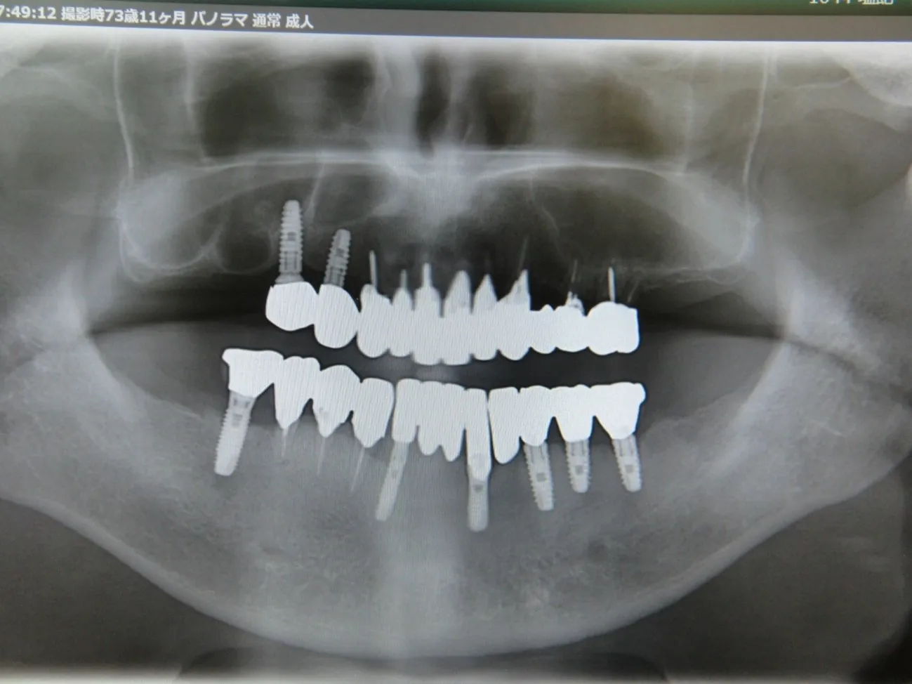 インプラント症例7