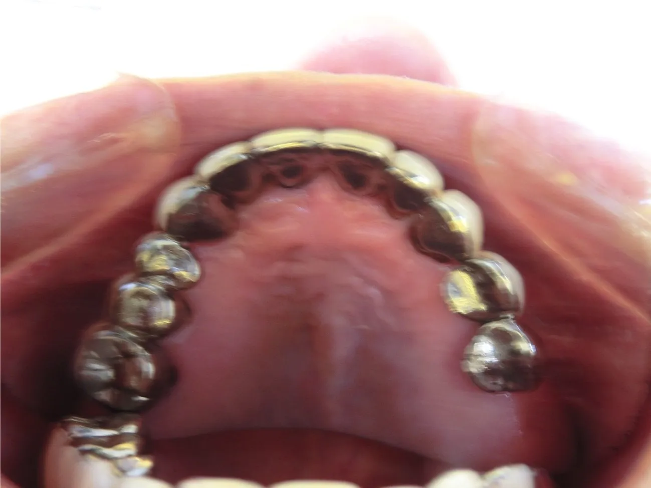 インプラント症例7