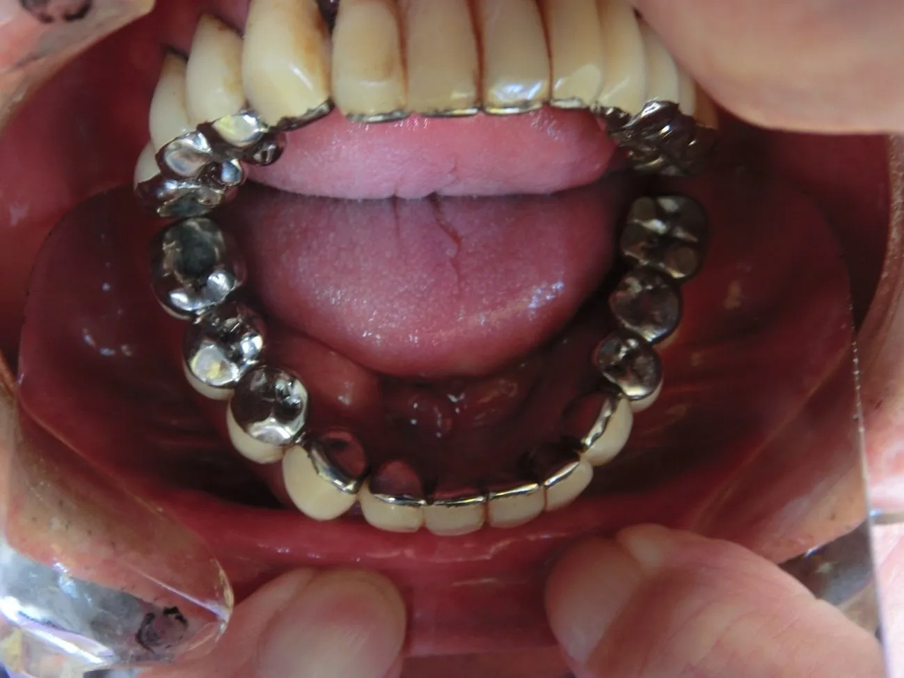 インプラント症例7