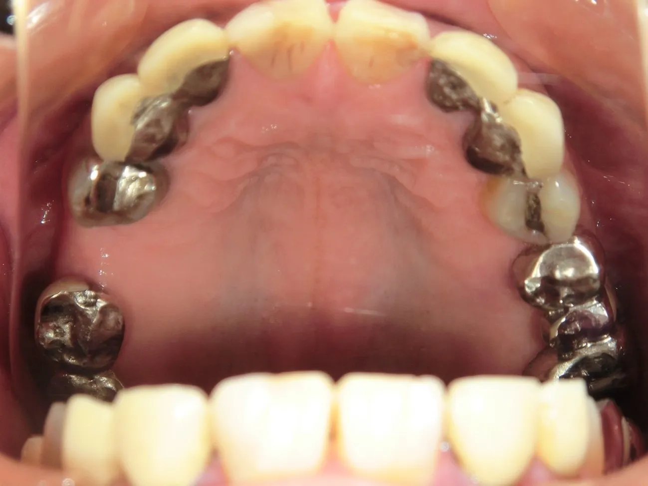 インプラント治療症例6