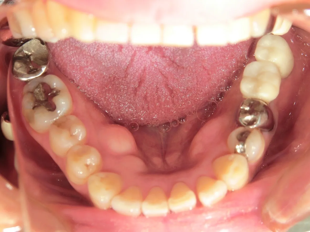 インプラント治療症例6