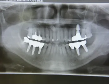 インプラント治療症例5インプラント治療症例5