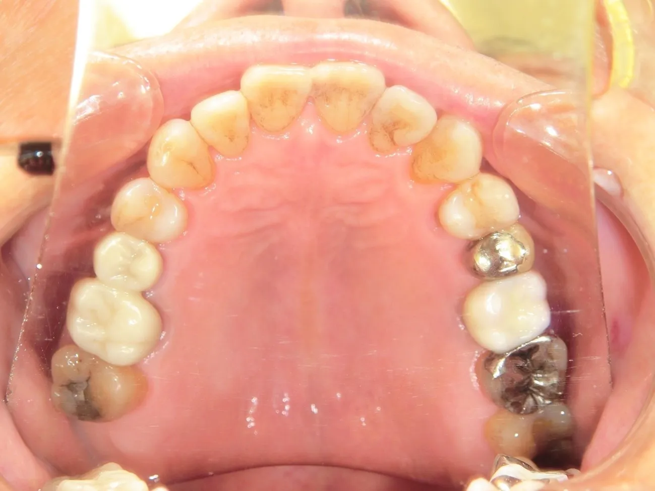 インプラント治療症例5インプラント治療症例5
