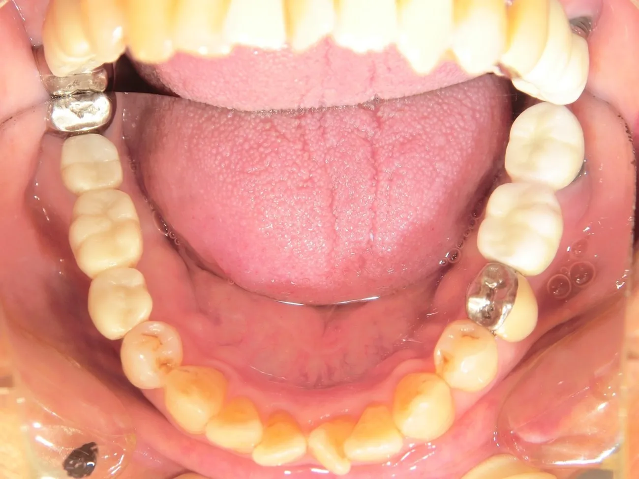 インプラント治療症例5インプラント治療症例5