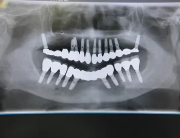 インプラント治療症例4