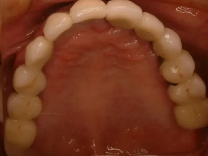 インプラント治療症例4