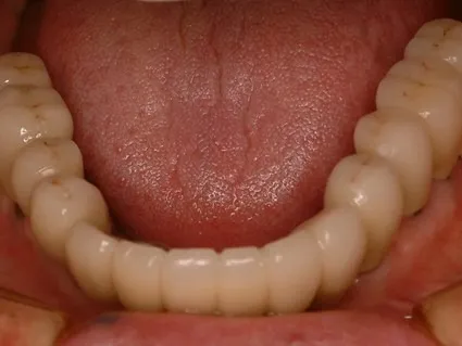 インプラント治療症例4