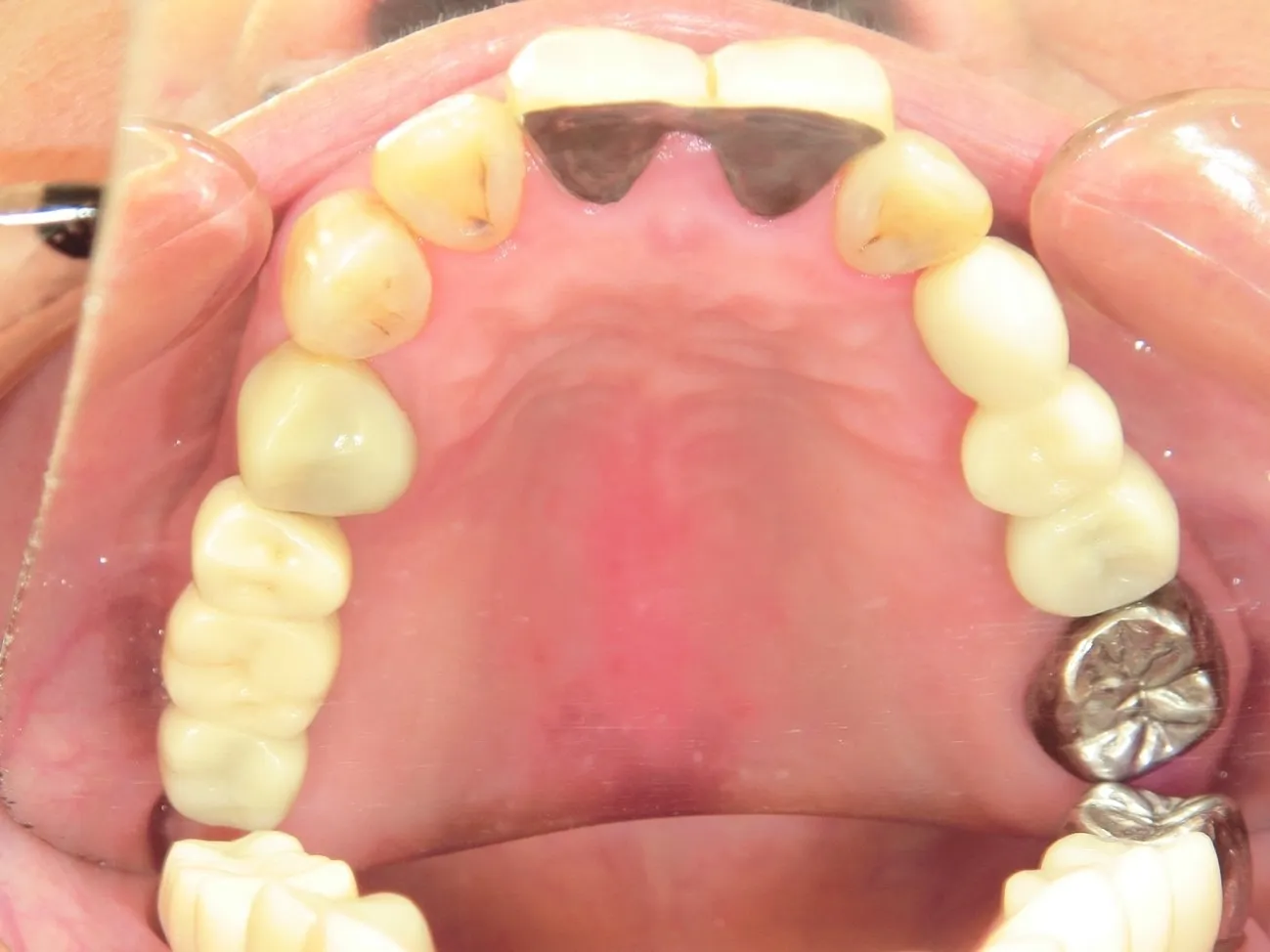 インプラント治療症例3