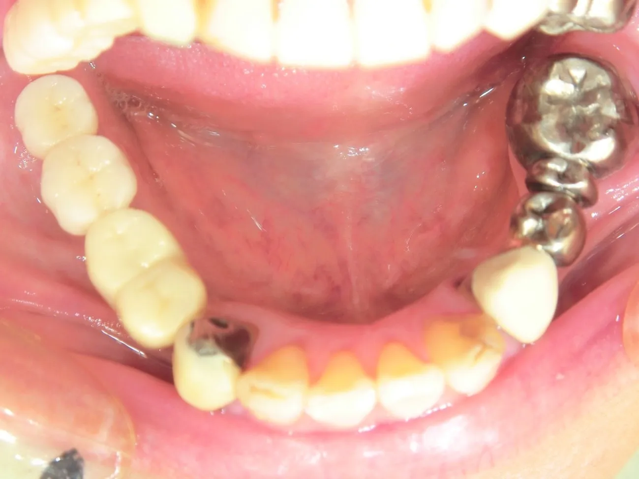 インプラント治療症例3