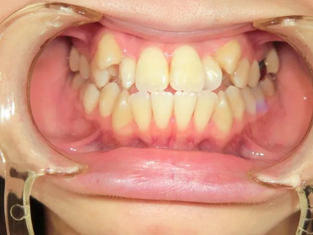 インビザライン治療前