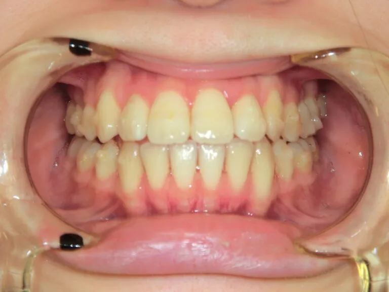 インビザライン矯正、抜歯か非抜歯か