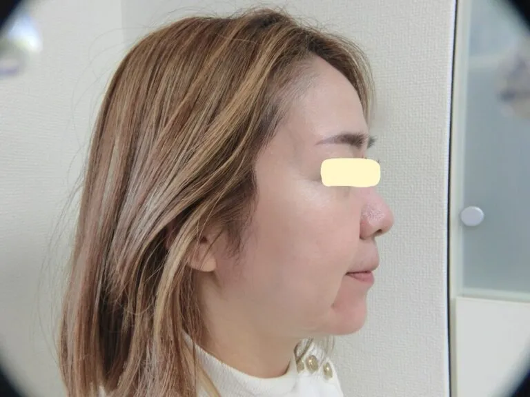 インビザライン矯正で若返った