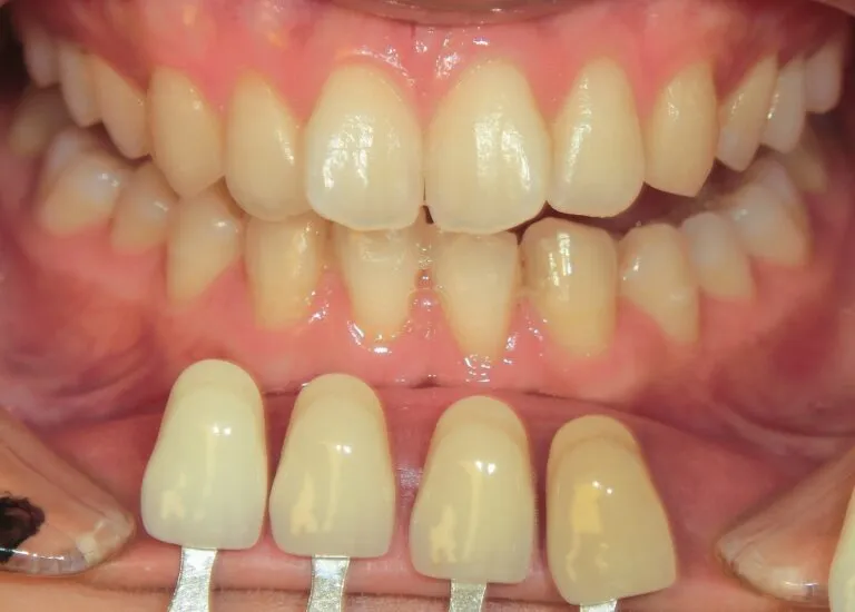 オフィスホワイトニング術前