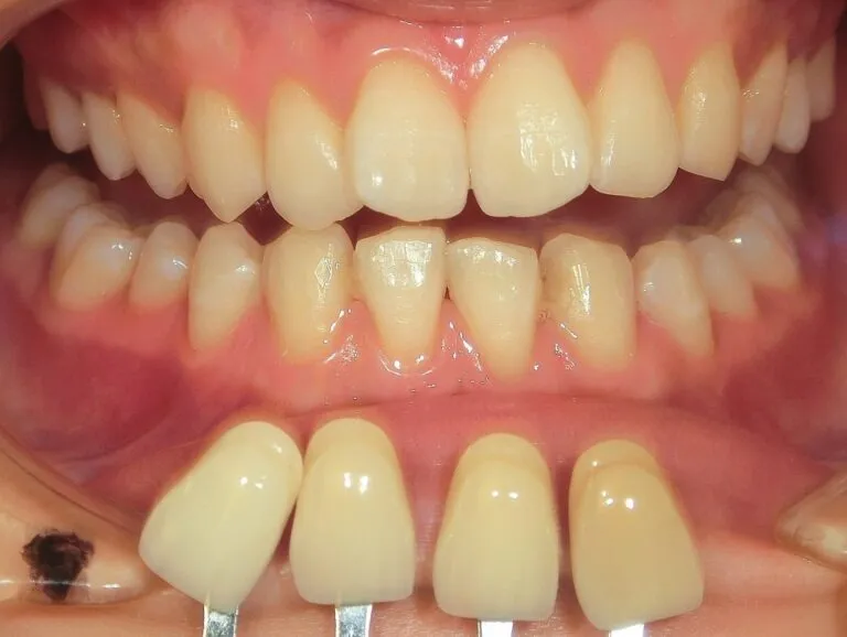 オフィスホワイトニング術後