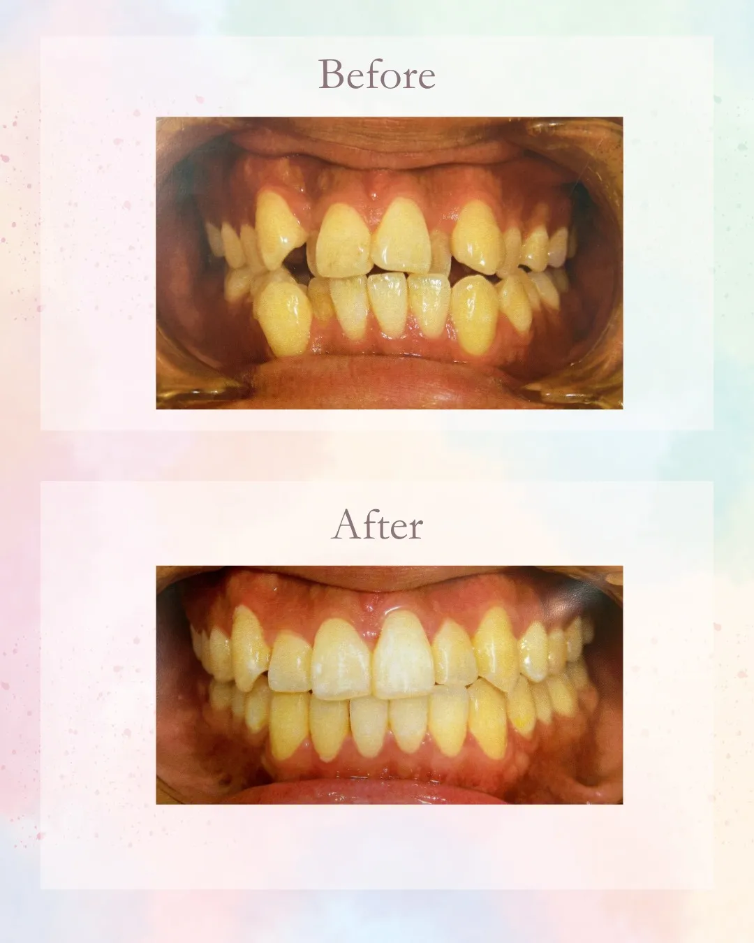 こんにちは！神戸元町　玉川歯科医院です🙂