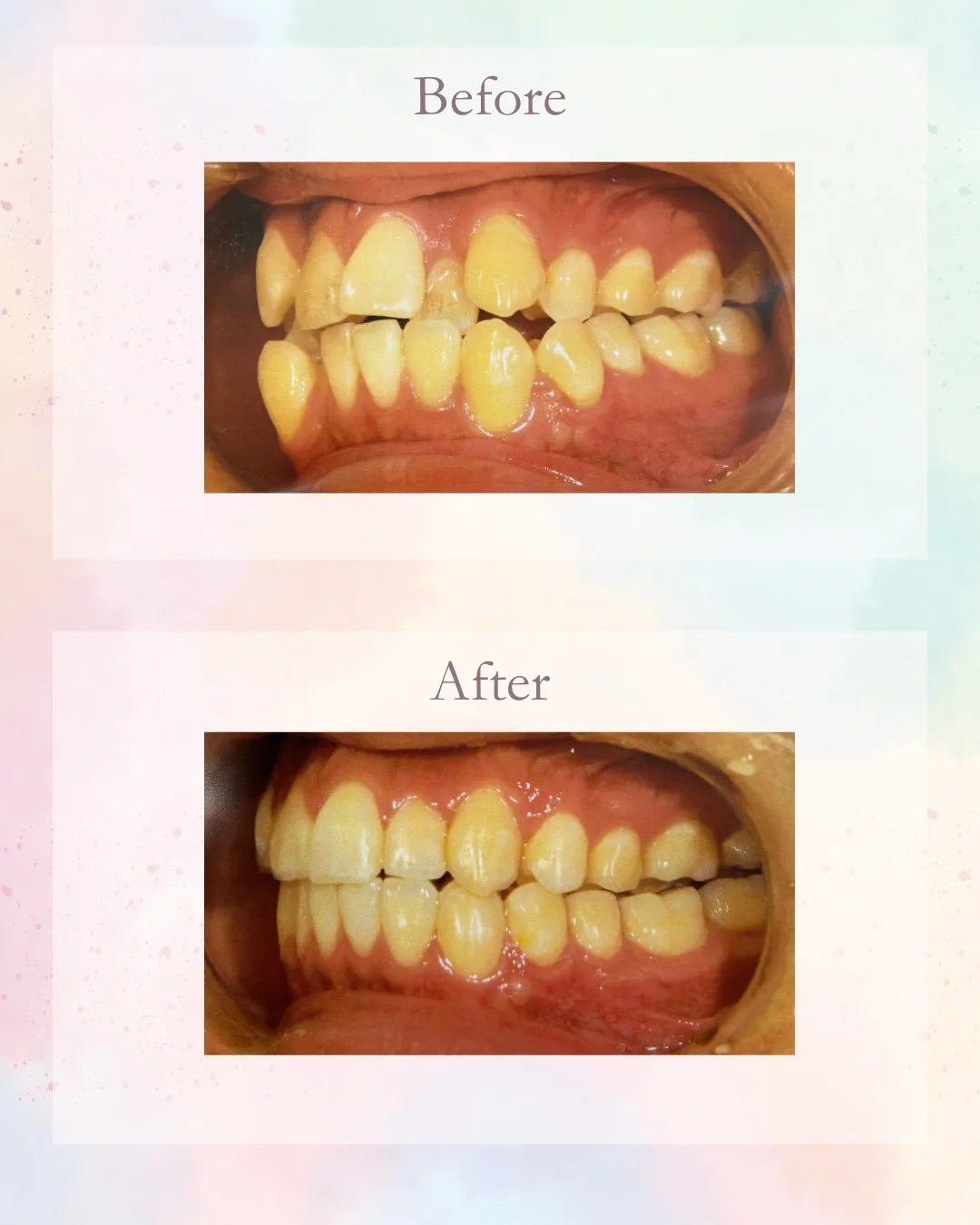 こんにちは!神戸元町 玉川歯科医院です🙂