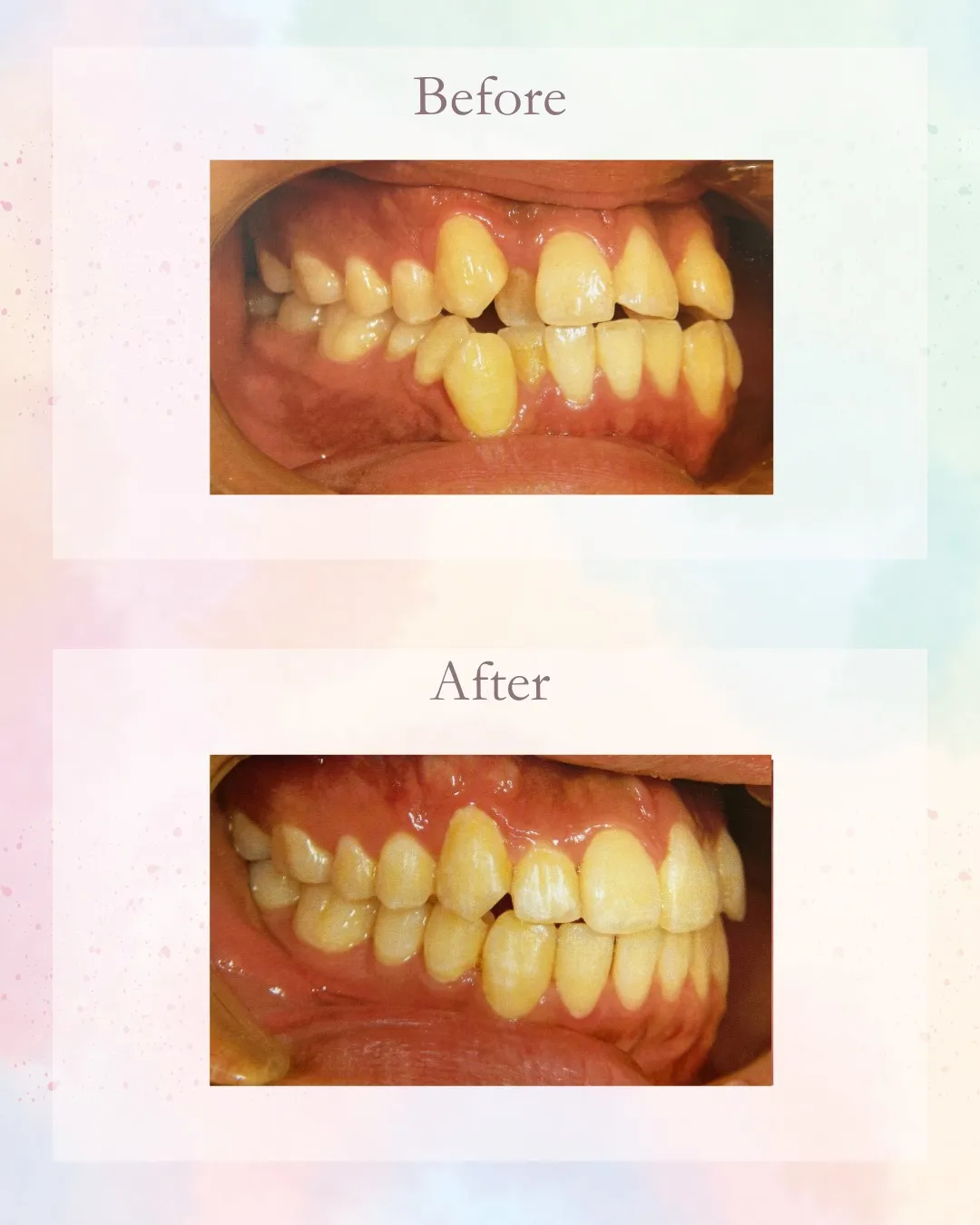 こんにちは!神戸元町 玉川歯科医院です🙂