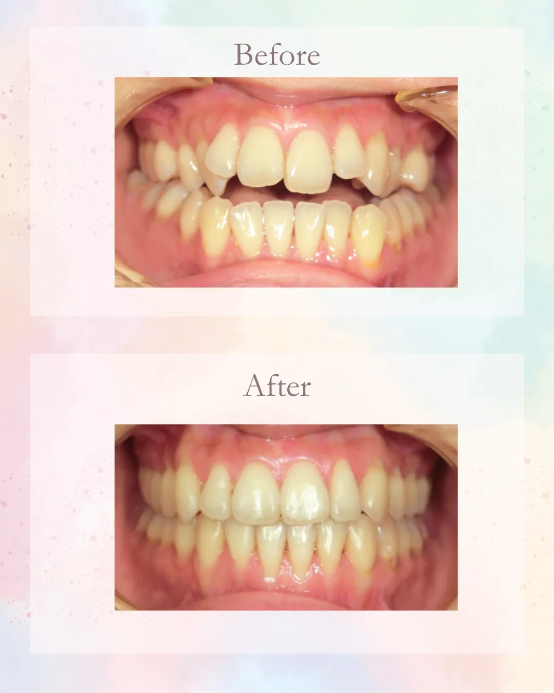 今日は開口の症例！こんにちは！神戸元町　玉川歯科医院です🙂