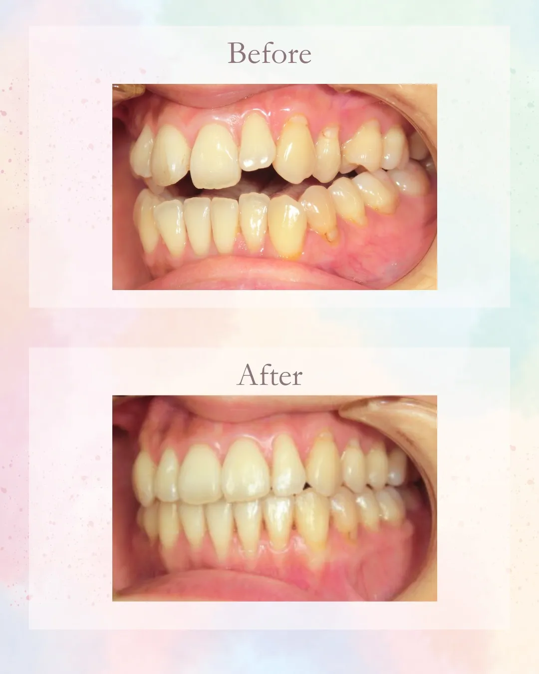 今日は開口の症例!こんにちは!神戸元町 玉川歯科医院です🙂