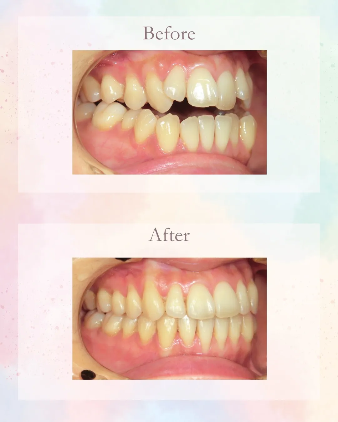 今日は開口の症例!こんにちは!神戸元町 玉川歯科医院です🙂