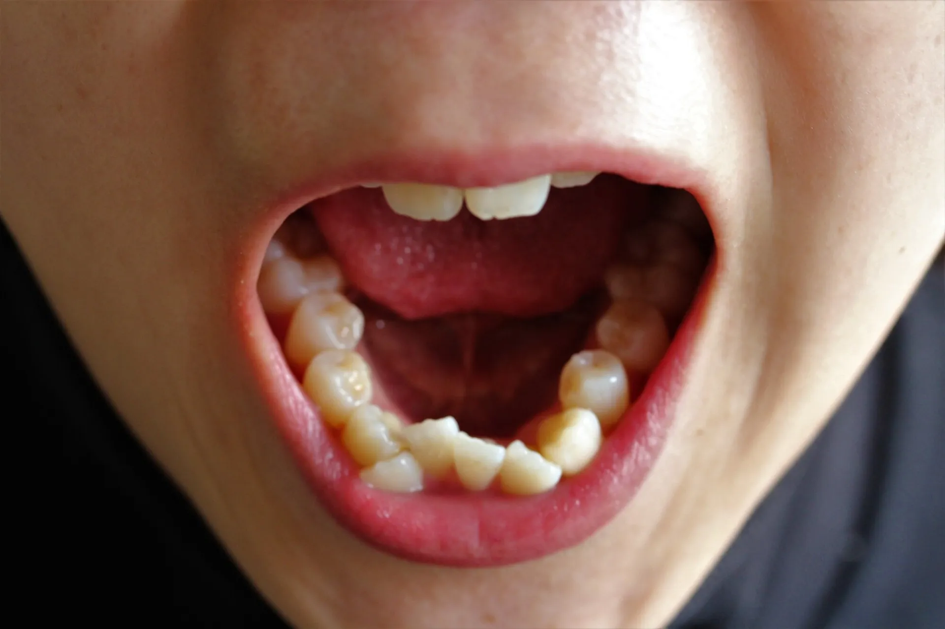 お子さんの矯正治療