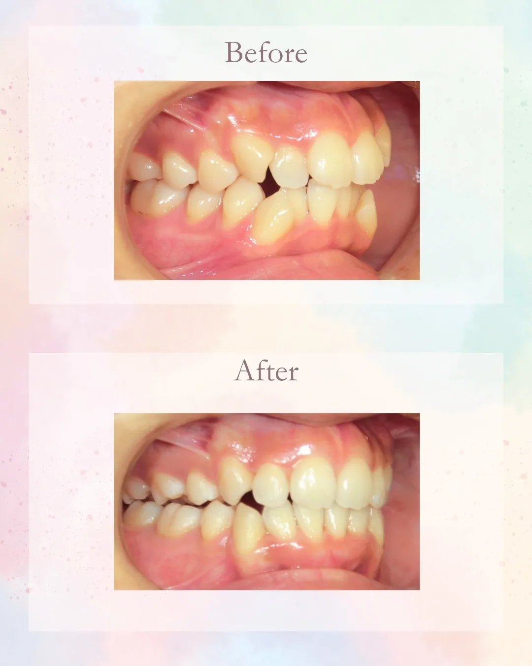 こんにちは!神戸元町 玉川歯科医院です🙂