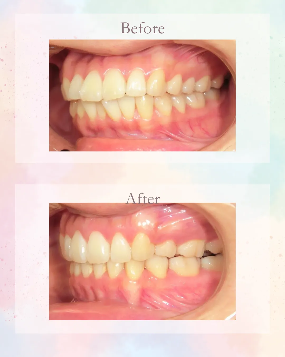 インビザライン症例2