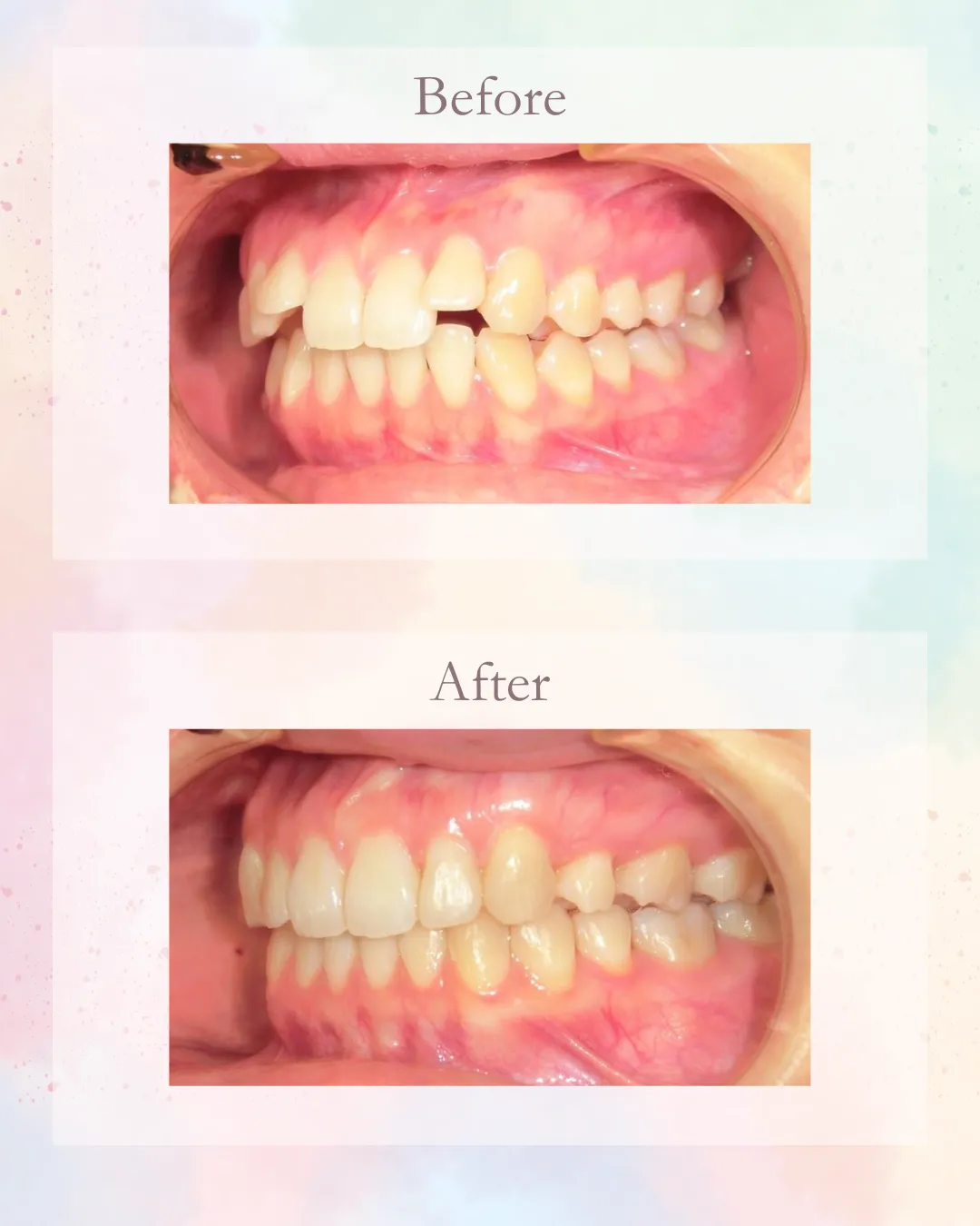 インビザライン症例3