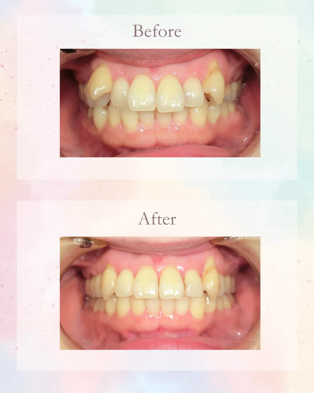 インビザライン症例4