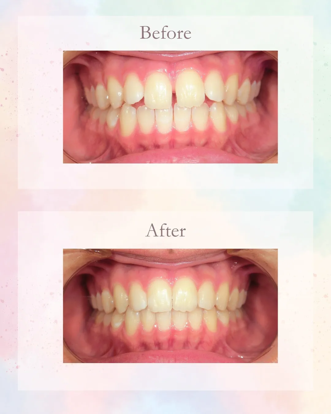 今日はすきっ歯の症例をご紹介！こんにちは！神戸元町　玉川歯科...