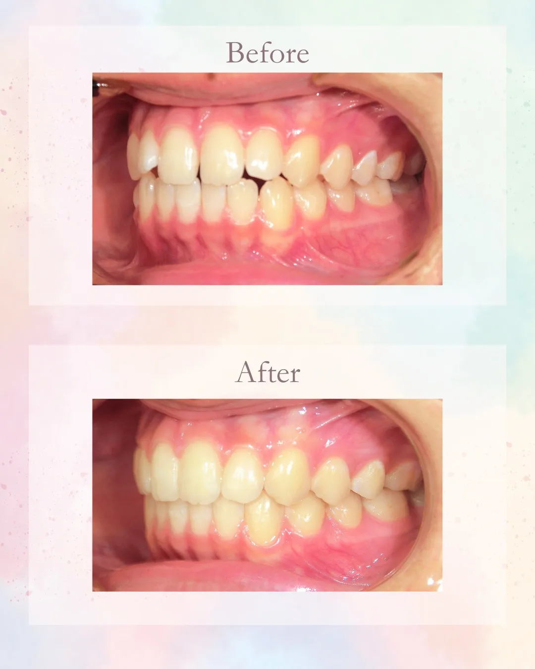 今日はすきっ歯の症例をご紹介！こんにちは！神戸元町　玉川歯科...