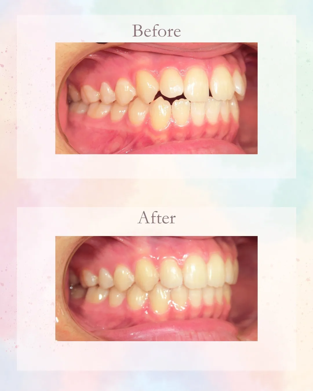 今日はすきっ歯の症例をご紹介！こんにちは！神戸元町　玉川歯科...