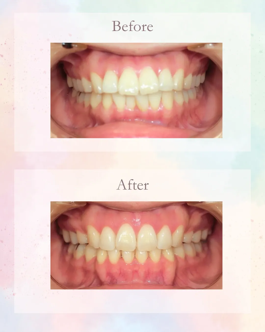 今日は前歯が出てるのを治した症例！こんにちは！神戸元町　玉川...