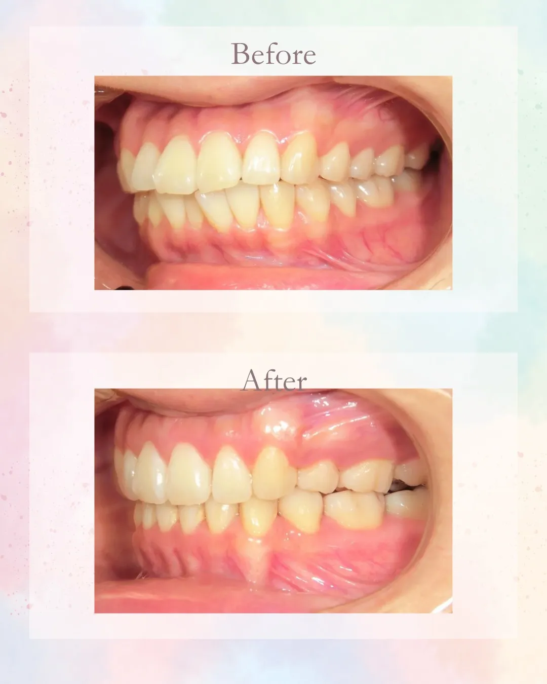 今日は前歯が出てるのを治した症例！こんにちは！神戸元町　玉川...