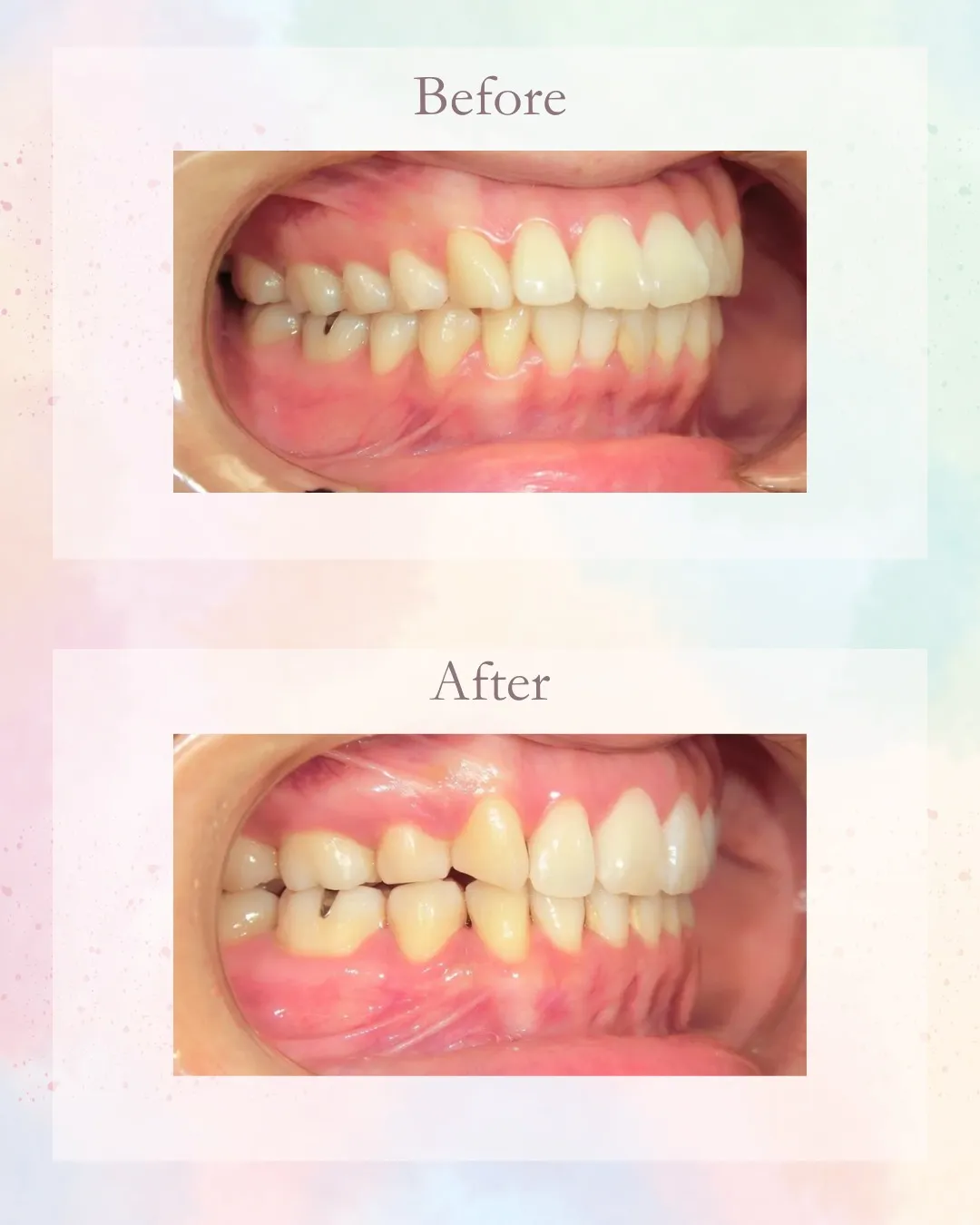 今日は前歯が出てるのを治した症例！こんにちは！神戸元町　玉川...